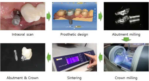Fig. 5. Workflow using intraoral scanner.