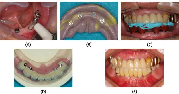 Fig. 2. (A) Resonace frequency analysis 3 months after implant placement. (B) Fixture level pick-up  impression  taken