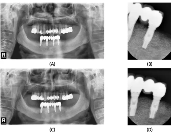 Fig. 3. Radiographic view taken immediately after delivery (A, B) and 7 years after loading (C, D).