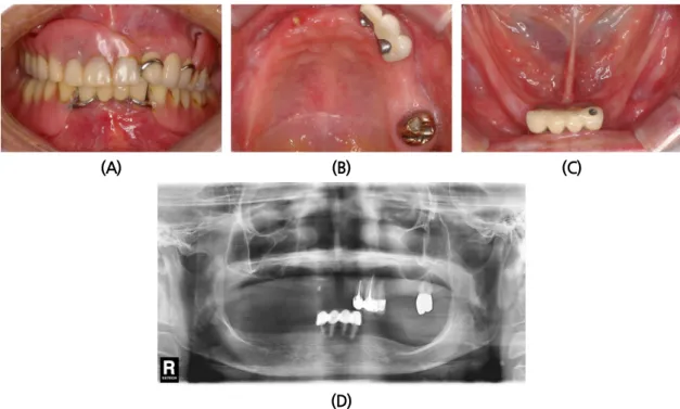Fig. 4. Preoperative clinical view (A, B, C) and radiographic view (D).