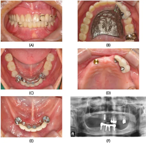 Fig. 6. (A, B, C) 7-unit surveyed metal-ceramic bridge and removable partial denture, (D) Magnet  attachment connected, (E) Intraoral photo: 4 years after loading, (F) Panoramic radiograph: 4 years  after loading.