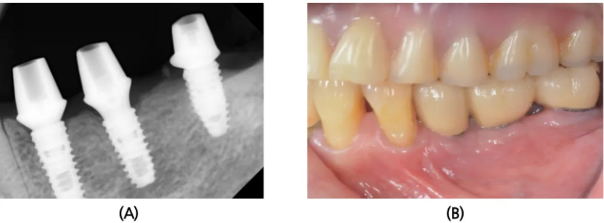 Fig. 12. Final prosthesis. (A) Abutment connection (2 months after fixture insertion)