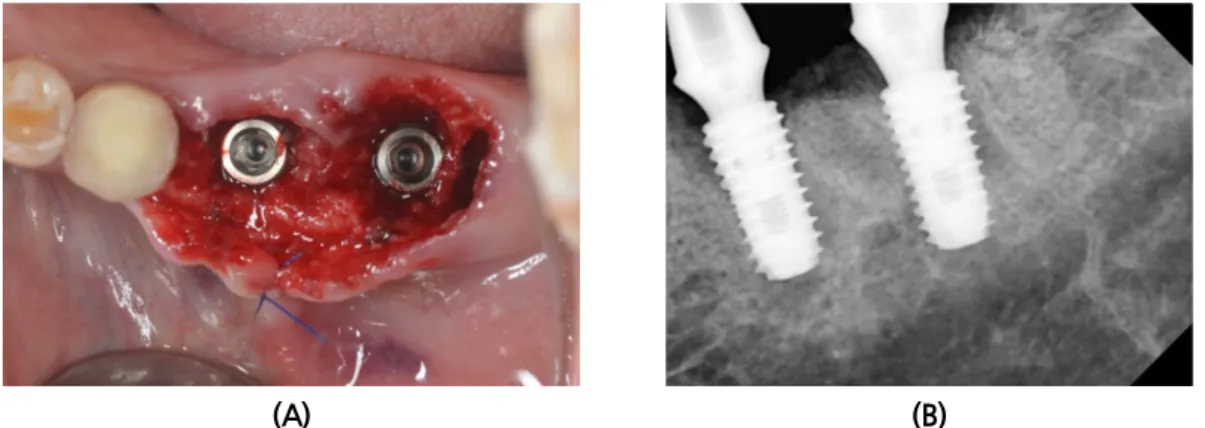 Fig. 2. Case #1. (A) Implants were installed at #36, 37 site. (B) Periapical radiograph on the day of  loading (early loading: 4 weeks after installation).