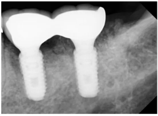 Fig. 3. Case #1. Periapical radiograph on the day of final delivery.