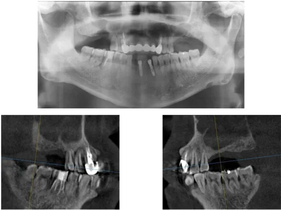 Fig. 5. Initial panoramic radiograph and CT scan. Haziness in both maxillary sinus (Case #2).