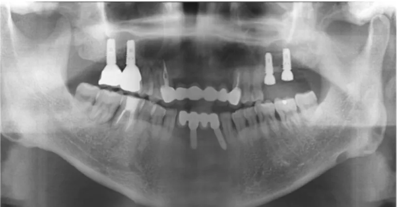 Fig. 7. After fixture installation in left maxillary molar area with sinus elevation (Case #2).