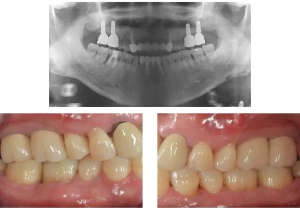 Fig. 8. Final prosthesis (Case #2).