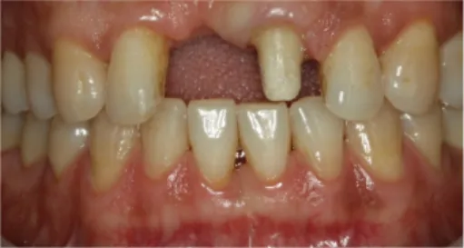 Fig. 2. Maxillary left incisor was prepared after extraction of maxillary right central incisor.