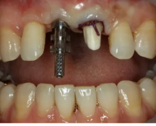 Fig. 8. Pick-up impression for provisional restoration.
