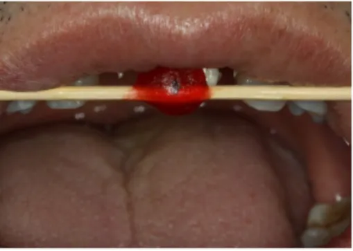 Fig. 13. Splinted prosthesis was delivered.