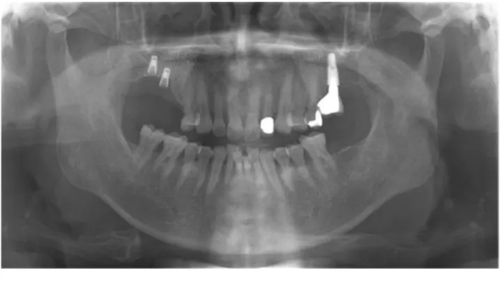 Fig. 1. Panoramic view X-ray. Note fractured implants at #16 and #17.
