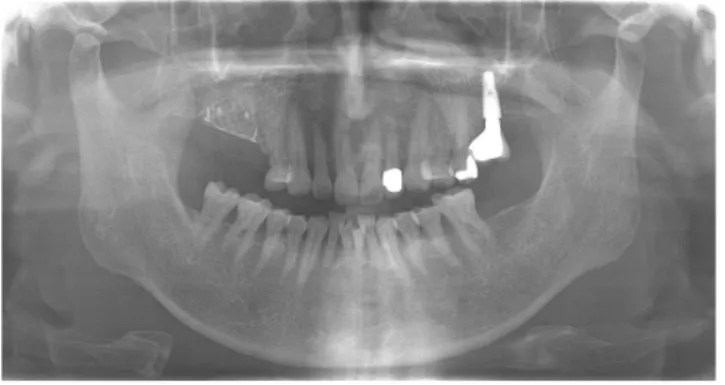 Fig. 3. Panoramic view X-ray following guided bone regeneration (GBR) at #16, #17.