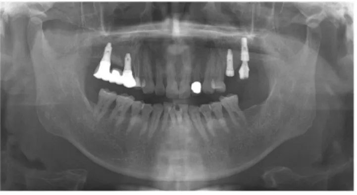 Fig. 5. Panoramic view X-ray following prosthesis delivery at #15 and #17.