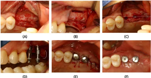 Fig. 3. Surgical procedures of hybrid technique at #26 and #27 implantation. (A) Flap was designed to  include midcrestal incision and vertical incision at distal line angle of #25