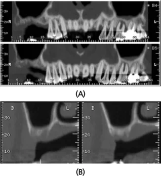 Fig. 6. In computed tomography views, (A) horizontal ridge resorption and pneumatized sinus at #16  and #17 with the inclined slope from the #16 was shown