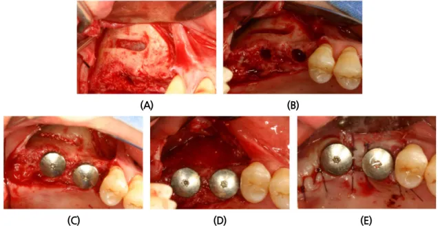 Fig. 7. Surgical procedures of hybrid technique at #16 and #17 implantation. (A) Linear shaped osteotomy centered at #17 sites and extended to the #16 at the lateral wall was prepared