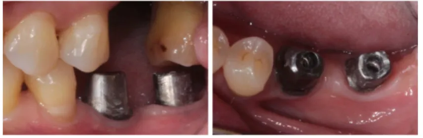 Fig. 29. Customized Titanium abutments were connected on #i36, i37.