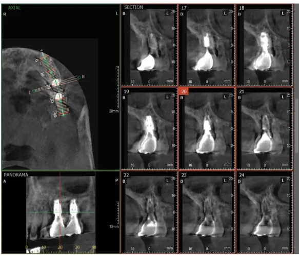 Fig. 32. Movement appeared on the CBCT image by patient.