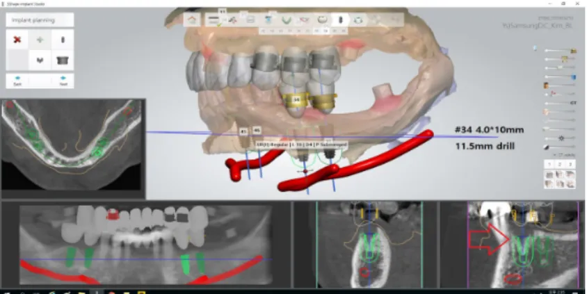 Fig. 5. 3D planning for implant position, customized abutment and provisional bridge (Implant Studio ® , 3Shape).