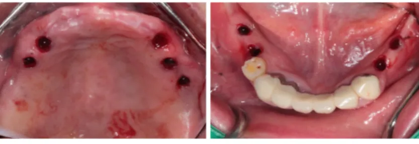 Fig. 9. After surgical drilling sequence, fixture was installed on each site.