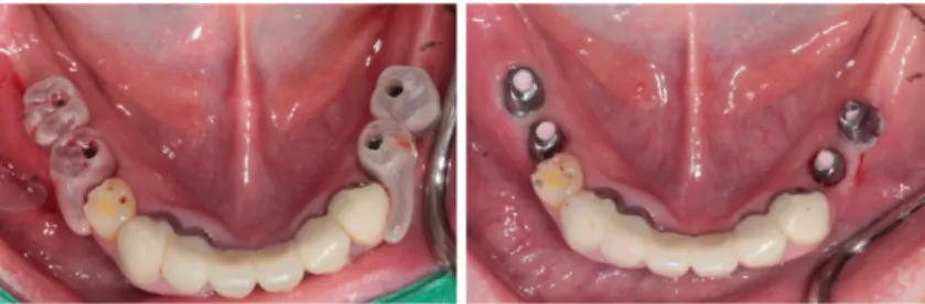 Fig. 13. Customized Titanium abutments were connected on mandible via positioning resin jig.