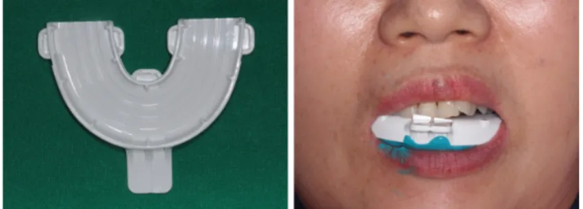 Fig. 20. R2GATE TM  tray for customized merging, and the tray positioned inside patient’s mouth with  bite material.