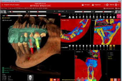 Fig. 23. 3D planning for implant position especially, analyzing bone density near the position (R2GATE TM , Megagen).