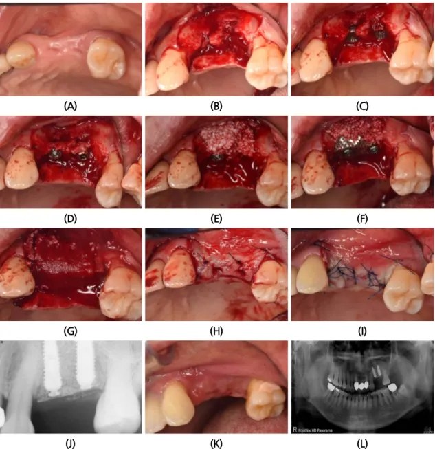 Fig. 2. (A) Pre-operative clinical photo. (B) In bucco-lingually, there are aberrant healing of extraction  site