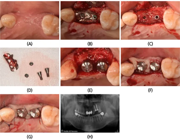 Fig. 3. (A) After 4 months healing period. (B) after 4 months, the state of titanium mesh