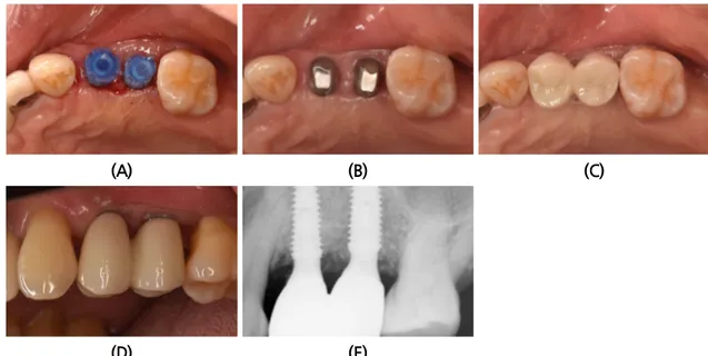 Fig. 4. (A) After the removal of healing abutment and connection of Pick Cap Impression coping for  impression taking
