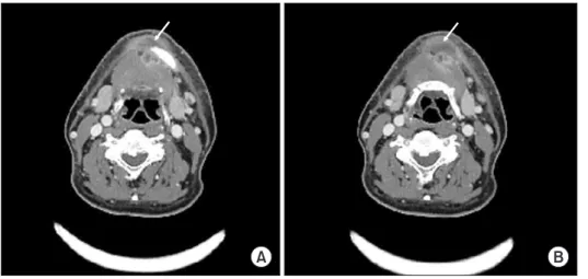 Fig. 1. Panoramic radiographic image (arrow) on first visit was  observed irregular bone erosion and bone loss of left mandible, but  no apparent bone destruction was observed.