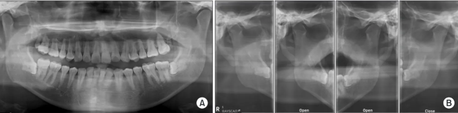 Fig. 1. Panoramic radiograph on the first visit. (A) Destruction of right maxillary sinus wall and haziness in right sinus were noted