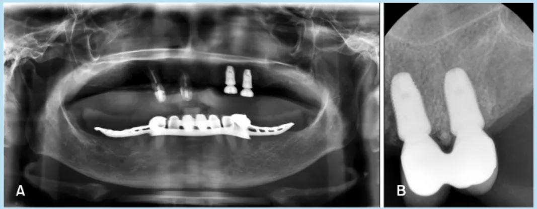 Fig.  3. 	 Panoramic	 view	 taken	 immediately	after	the	surgery	(A)	and	 periapical	 view	 11	 months	 after	 loading	(B).