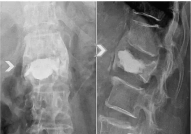 Fig.  1.  Solid  fusion  group  defined  fractured  vertebrae  which  continuity  was  achieved  in  at  least  3  adjacent  cortical  vertebrae.