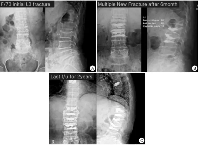 Fig.  3.  (A)  A  69  years  old  female  had  3 rd   lumbar  vertebrae  fracture  with  minor  trauma,  (B)  Six  month  later  with  L3  vertebroplasty,  adjacent  level  fracture  were  occurred  and  repeated  vertebroplasty,  (C)  Multiple  level  fra