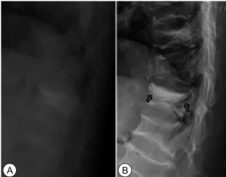 Fig.  2.  Vertebral  collapse  with  cement  destruction  of  75  years  olds  man.  (A)  Immediately  post  vertebroplasty  state  of  L1,  (B)  In  follow  up  X-ray  after  5.5years,  mild  vertebral  collapse  with  increased  focal  kyphotic  angle  i