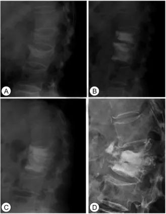 Fig.  3.  Osteoporotic  compression  fracture  of  L1,2  :  70  years  olds  women.  (A)  Initial  X-ray  shows  osteoporotic  compression  of  L1,L2,  (B)  post  percutaneous  vertebroplasty  state,  (C)  post  OP  2years  follow  up  X-ray  -  shows  a  