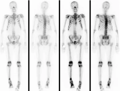Fig.  3.  Bone  scintigraphy  showed  multiple  focal  increased  uptake  in  nasal  bone,  T9-T12  spines,  sternum,  both  ribs,  both  scapula,  both  pubic  superior  ramus,  both  distal  femur,  both  proximal  tibia  and  right  distal  tibia  (Case
