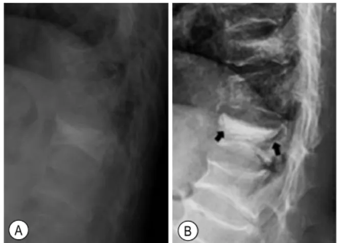 Fig.  2.  Visual  analogue  scale  (VAS)  score  was  decreased  and  then  maintained  after  percutaneous  