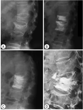 Fig.  5.  Simple  lateral  radiographs  of  a  70-year-old  woman  with  L1,2  compression  fracture