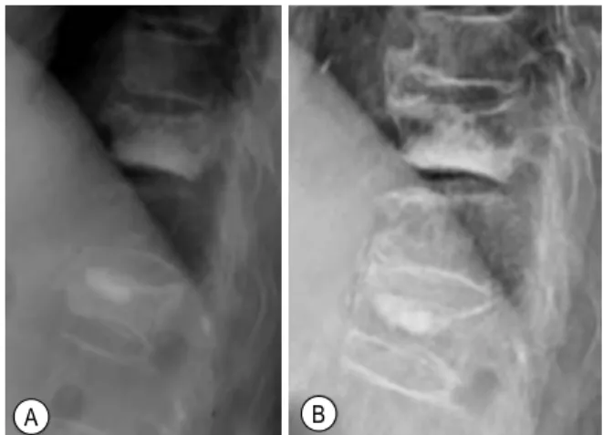 Fig.  6.  Computered  tomography  (CT)  and  magnetic  reso- reso-nance  image  (MRI)  of  a  70-year-old  woman  with  L1,2compression  fracture