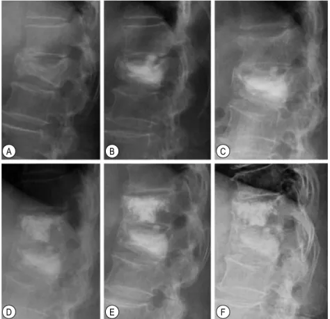 Fig.  8.  Simple  lateral  radiographs  of  a  73-year-old  woman  with  L1,T12  compression  fracture