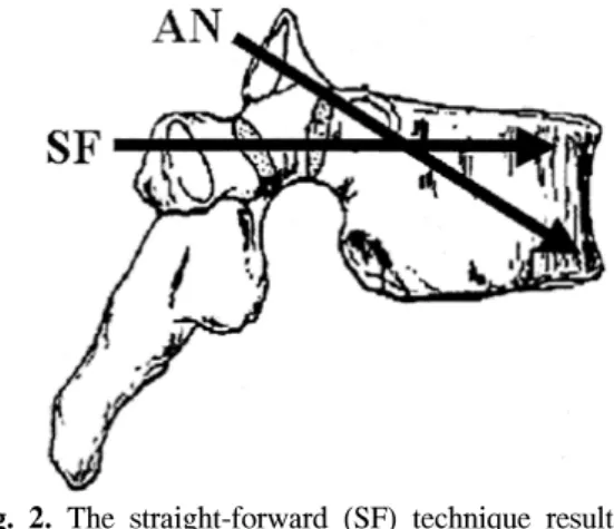 Fig.  1.  Preservation  of  dorsal  cortex  and  convergence  angle  is  important  to  enhance  fixation  stability.