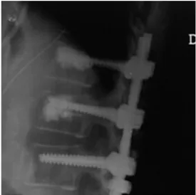 Fig.  3.  The  most  common  method  for  vertebral  body  augmentation  is  adding  with  bone  cement.