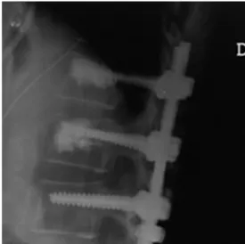 Fig.  3.  The  most  common  method  for  vertebral  body  augmentation  is  adding  with  bone  cement.