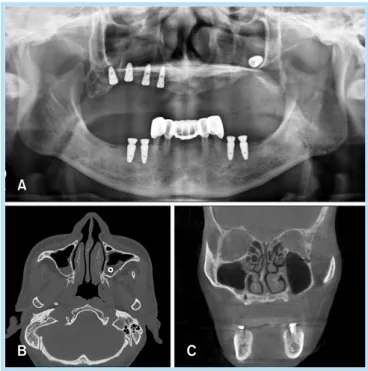 Fig.  3. 	 (A)	 Preoperative	 panoramic	 radiograph.	 (B)	 Preoperative	 computed	 tomography	 images.	 (C)	 Postoperative	computed	tomography	images,	6	weeks.