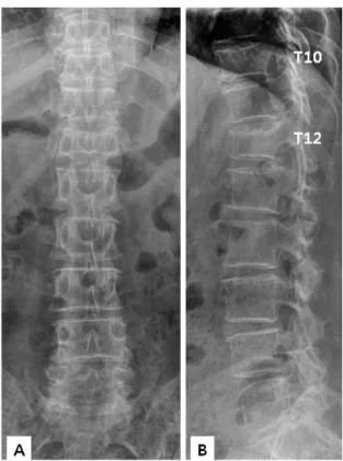 Fig.  2.  Thoracolumbar  MRI  shows  acute  osteoporotic  spinal  fractures  on  T10  and  T12