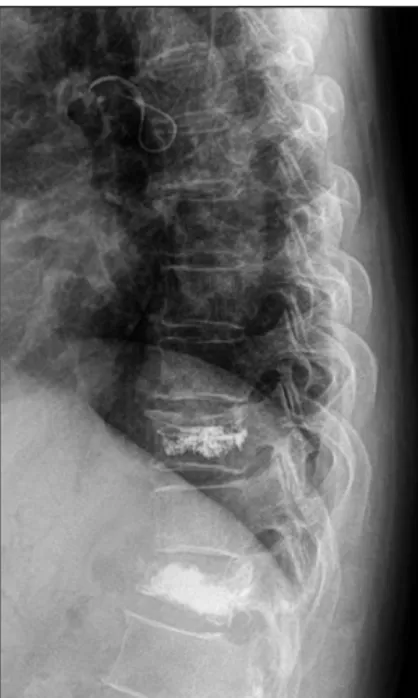 Fig.  5.  At  the  12  months  after  kypoplasty,  lateral  thora- thora-columbar  X-ray  show  no  interval  change  with  postoperative  X-ray.