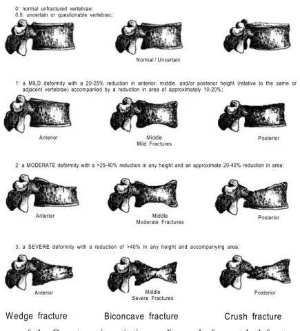 Fig.  1. Schematic  diagram  of  the  Genant  semiquantitative  grading  scale  for  vertebral  fracture,  is  classified  into  four  grades  (from  0  to  3)  according  to  the  degree  of  collapse  (From  Genant  et  al 17 ).