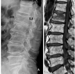 Fig.  6.  A  87-  year-  old  man  with  occult  osteoporotic  vertebral  fracture  of  L1  (A),  confirmed  by  MRI  (B)